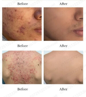 Krema za smanjenje pora