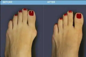 Longeta za ispravljanje čukljeva