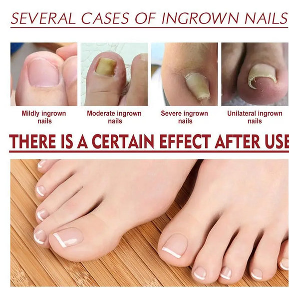 Ulje za urasle nokte - Slika 13