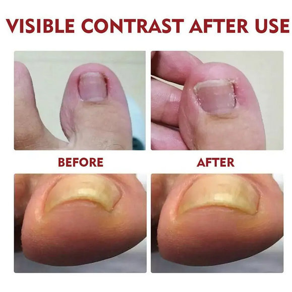 Ulje za urasle nokte - Slika 14