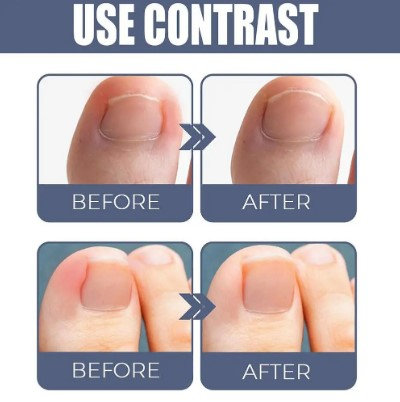 Ulje za urasle nokte - Slika 6