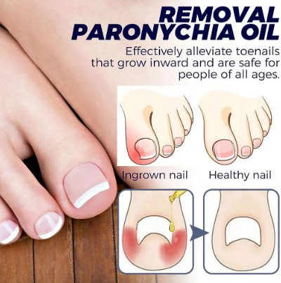 Ulje za urasle nokte - Slika 7